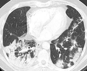 Pulmonary CT angiography to assess pulmonary embolism (PE) obtained on illness day 21. CT axial image (lung window) showed peripheral areas of consolidation in both lower lobes. Incipient architectural distortion is seen in central portions of the lungs. CT findings were suggestive of OP. PE was absent.