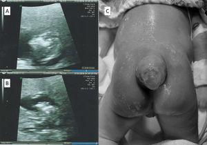 A and B: Case 1—anencephaly at ultrasound, C: Case 2—spina bifida at preoperative.