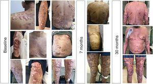 Evolution of lobomycosis lesions in a patient chronic renal failure on treatment with posaconazole.