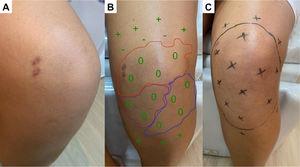 (A) Hypochromatic, hypo-anesthetic macule on the left knee; (B) Areas with loss of tactile sensitivity [anesthetic (0), hypoesthetic (-) and normoesthesic (+) points to green monofilament (0.07 g-f, normal threshold of tactile sensitivity); blue dashed area = 0.2 g-f; purple dashed area = 2.0 g-f; red dashed area = 4.0 g-f); (C) improvement of tactile sensitivity after six months of multibacillary multidrug therapy.