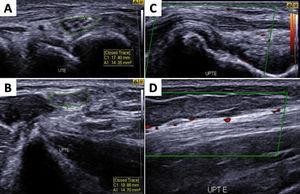 Ultrasonography showing asymmetric neuropathy at the left ulnar nerve with thickened transverse sectional areas in the cubital tunnel (A-UTE) and in the distal region of the arm (B-UPTE) with hyperechoic perineurs and evident fascicular distention (C), in addition to blood flow in the epineural and intraneural region (D) as a sign of active neuritis.