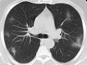 Typical CT imaging features for COVID-19 pneumonia. Axial unenhanced CT image of the lungs in a 61-year-old man with a positive RT-PCR showing bilateral, multifocal rounded and peripheral GGO.