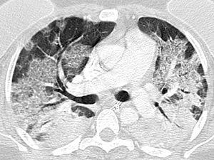 Indeterminate CT imaging features for COVID-19 pneumonia. Axial contrast-enhanced chest CT image of the lungs in a 41-year-old female with a positive RT-PCR, showing bilateral widespread GGO with nonrounded morphology and no specific distribution with areas of consolidation.