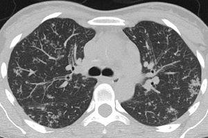 Atypical CT imaging features for COVID-19 pneumonia. Axial unenhanced chest CT image of the lungs in a 37-year-old control patient showing tree-in-bud opacities and centrilobular nodules, caused by active tuberculosis.