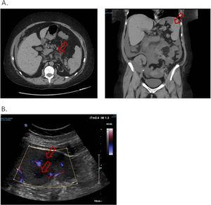A. Non-injected abdominopelvic scan. Duodeno-jejunitis with heterogeneous circumferential wall thickening and densification of fat around the duodenojejunal frame. Peri hepato-splenic, inter-anses, parietal-colic gutters and pouch of Douglas peritoneal effusion of great abundance. Multiple hypodense splenic nodules. B. Splenic Doppler ultrasound. Non-vascularized hypoechoic lesions with Doppler energy, some with a target appearance.