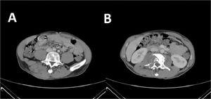 CT scan after the second treatment failure with Meropenem 2g three times a day, amoxicillin/clavulanic acid three times a day, linezolid 600 mg two times a day, and levofloxacin 500 mg two times a day. (A) presence of cutaneous abscess; (B) Presence of osteomyelitis on the second lumbar vertebra.