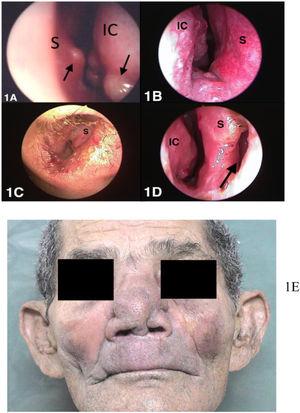 Clinical aspects of mucosal leishmaniasis at different stages of the disease. (1A and 1B) Stages I and II: mild forms of mucosal leishmaniasis. (1C, 1D and 1E) Stages III, IV and V respectively: severe forms of mucosal leishmaniasis. IC, inferior conchae; S, septum.3.