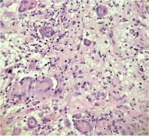 Photomicrograph of the perianal region revealing a chronic inflammatory process with an outline of granulomas consisting of epithelioid macrophages, giant multinucleated Langhans cells (thick arrow), and lymphocytic infiltrate (arrowhead) (H&E 400 ×).