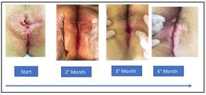 Perianal region. The lesion´s evolution over time with treatment with a tuberculostatic regimen.