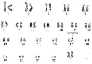 T-cell/myeloid Mixed-phenotype Acute Leukemia With Monocytic ...