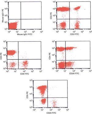 Immunophenotype by flow cytometry of the peripheral blood showing abnormal T-cells – CD3− CD5+, CD4+, CD26partial.