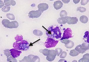 Arrows show phagocytes containing one or more intracellular Histoplasma capsulatum (magnification: 1000×; May-Grünwald stain).