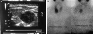 A: ecografía cervical en la que se observa un nódulo no homogéneo y de patrón mixto de 2,6×2,7cm, con vaso central. B: gammagrafía paratiroidea con 99mTc-MIBI, en la que se observa foco de hipercaptación en el polo inferior del lóbulo tiroideo derecho, persistente en ambas fases. C: estudio macroscópico de la tumoración, lobulada, de 3cm, rodeada de seudocápsula fibrosa, con invasión vascular. D: examen microscópico, con células en patrón trabecular, con mitosis y focos de necrosis.