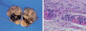 A: ecografía cervical en la que se observa un nódulo no homogéneo y de patrón mixto de 2,6×2,7cm, con vaso central. B: gammagrafía paratiroidea con 99mTc-MIBI, en la que se observa foco de hipercaptación en el polo inferior del lóbulo tiroideo derecho, persistente en ambas fases. C: estudio macroscópico de la tumoración, lobulada, de 3cm, rodeada de seudocápsula fibrosa, con invasión vascular. D: examen microscópico, con células en patrón trabecular, con mitosis y focos de necrosis.
