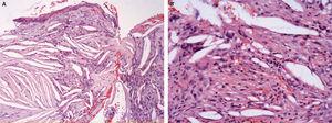 A: abundantes espacios aciculares ópticamente vacíos (cristales de colesterol) en el seno de tejido fibroso. Revestimiento parcial por epitelio escamoso (H-E, ×100). B: el infiltrado inflamatorio comprende células gigantes multinucleadas e histiocitos (H-E, ×200).