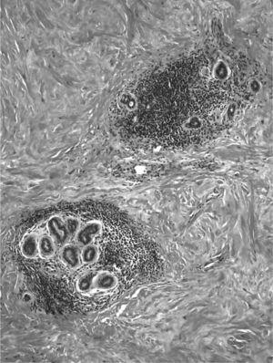 Fibrosis densa estromal, de tipo queloidea, e infiltrado linfocitario periductal y perilobulillar (H-E, ×4).