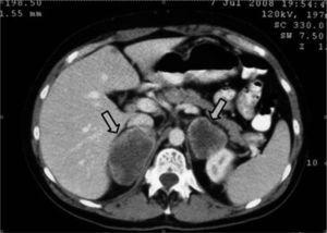 Tomografía computarizada abdominal: masa adrenal derecha de 5,5 × 4 × 8,6 cm y masa adrenal izquierda de 4,6 × 4 × 5 cm.
