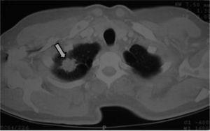 Tomografía computarizada torácica: nódulo espiculado de 2 cm en ápex pulmonar derecho.
