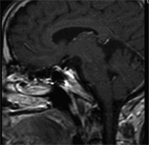 Resonancia magnética cerebral que muestra hipoplasia de tallo hipofisario e hipófisis anterior.