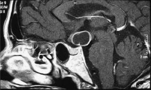 Resonancia magnética cerebral que muestra lesión quística con engrosamiento de quiasma óptico y obliteración del tercer ventrículo sugerente de craneofaringioma.