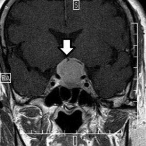 Resonancia magnética nuclear centrada en hipófisis con cortes finos, donde se aprecia la cola dural característica del meningioma (flecha).