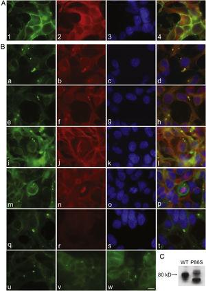 Characterization of endoplasmic reticulum (ER) bodies induced by P86S. HEK 293 cells stably expressing WT GCGR-EGFP (Panel A) or P86S-EGFP (Panel B) were fixed and immunofluorescently stained with antibodies against calregulin (2, b), glucosidase II (f), α tubulin (j, n), or ubiquitin (r). The images of WT GCGR-EGFP (1) or P86S-EGFP (a, e, i, m, and q, in green), various cellular markers (2, b, f, n, and r, in red), and nuclei (3, c, g, k, o, and s, in blue) were overlaid (4, d, h, l, p, and t). Yellow or orange shows colocalization of green and red fluorescence. HEK 293 cells stably expressing P86S-EGFP were also treated with proteasome inhibitor LLnL (50μM) (u), microtubule depolymerizer colcemid (100 ng/ml) (v), or both (w), for 8hours. C) Differential processing of WT GCGR-EGFP and P86S-EGFP. HEK 293 cells stably expressing WT GCGR-EGFP and P86S-EGFP were lysed and subjected to western blot using antibody against EGFP. Time of image acquisition is indicated at the left low corner. These results demonstrated that the circular ER bodies are not aggresomes. Bar, 10μm. EGFP: enhanced green fluorescent protein; GCGR: glucagon receptor.