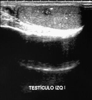 Ecografía testicular que muestra lesión hipoecoica de márgenes irregulares en testículo izquierdo, e imágenes compatibles con microlitiasis dispersas.