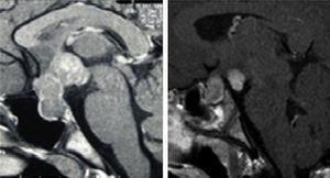 Hypophyseal MRI findings, Sagittal acquisitions, TI-sequencing after gadolinium contrast injection. Case 1. Hypothalamic-hypophyseal lesion affecting both cavernous sinuses, compression of the optic chiasm and deformation of the third ventricle. Case 2. Thickening of the hypophyseal stalk and enhanced uptake nodule in the tuber cincrcum, measuring 7mm in size.