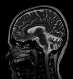 Resonancia magnética cerebral con contraste de gadolinio en la que se evidencia un aumento en la amplitud y profundidad del cerebelo compatible con atrofia cerebelosa.