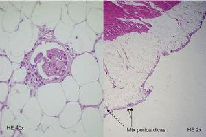 Metástasis pericárdicas de carcinoma papilar de tiroides.