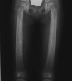 Radiografía anteroposterior de ambos fémures donde podemos observar una hiperostosis irregular y simétrica de las diáfisis ambos huesos.