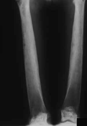 Radiografía anteroposterior de ambas tibias en la que se aprecia un engrosamiento bilateral de las diáfisis de ambos huesos, tal y como hemos descrito en los pacientes afectados de síndrome de Camurati-Engelmann.