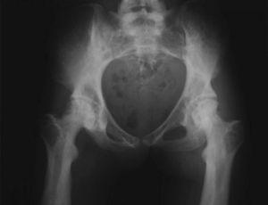 Radiografía anteroposterior de la pelvis en la que podemos apreciar una hiperostosis irregular de esta.