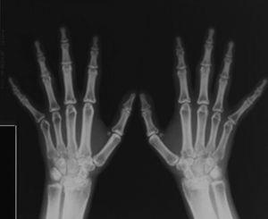 Radiografía anteroposterior de las manos en la que se aprecia un engrosamiento de los huesos del carpo, de las diáfisis de los metacarpianos y de las falanges de ambas manos.