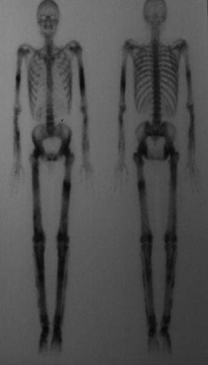 Gammagrafía ósea característica de la enfermedad de Camurati-Engelmann en la que podemos observar un aumento de la captación simétrica en las diáfisis de los huesos largos (fémur, tibia, húmero, cúbito) y de la pelvis.