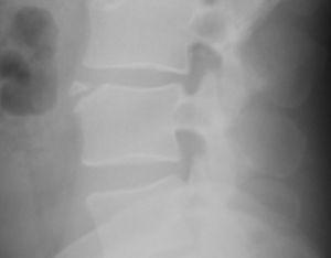 Lateral radiografi af lændehvirvelsøjlen. Osicle med trekantet morfologi og veldefineret kant af kortikal knogle, placeret ved den anterosuperior vinkel på L4, adskilt fra resten af rygsøjlen med et radiolucentbånd.