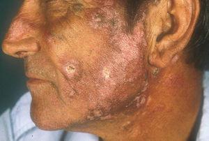 Placas eritematosas, con centro atrófico y bordes hiperpigmentados, correspondiente a lupus eritematoso cutáneo crónico.