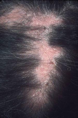 Placa de alopecia cicatricial en cuero cabelludo.
