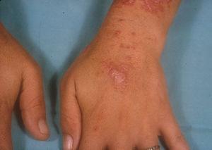 Lesiones en dorso de manos, variante papuloescamosa del lupus eritematoso cutáneo subagudo.