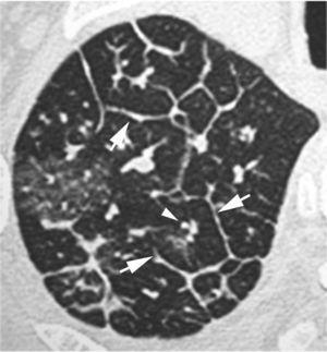 Imagen TCAR localizada en el lóbulo superior derecho que muestra un engrosamiento septal interlobular liso (flechas) en un paciente con edema pulmonar. Vease la localización centrolobulillar de la arteriola pulmonar (punta de flecha).