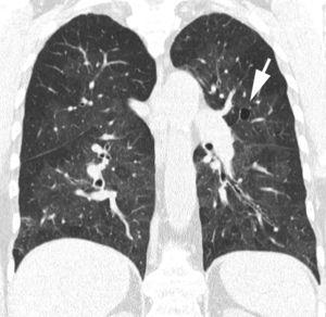Imagen TCMD reconstruida en el plano coronal, en un paciente con neumonía intersticial linfocítica, que muestra extensas opacidades pulmonares bilaterales en «vidrio deslustrado». Imagen quística aérea en el lóbulo superior izquierdo (flecha).