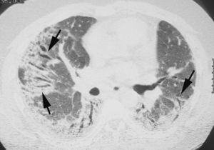 Imagen TCAR en paciente con artritis reumatoide que muestra opacidades reticulares, dilataciones bronquiales y bronquiectasias de tracción de localización periférica (flechas). Los hallazgos corresponden a un patrón de neumonía intersticial no específica (NINE).