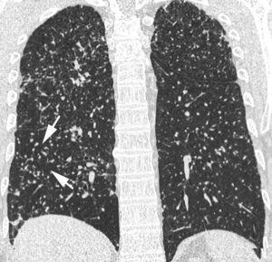 Imagen TCAR en reconstrucción multiplanar en plano coronal que muestra múltiples nodulillos pulmonares de distribución aleatoria, correspondiente a patrón miliar (flechas).