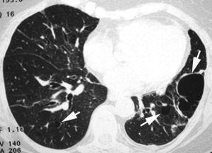 Imagen TCAR localizada en lóbulos inferiores que muestra múltiples imágenes quísticas pulmonares bilaterales.