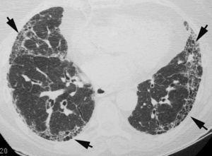 Imagen TCAR localizada en lóbulos inferiores en paciente con fibrosis pulmonar idiopática; destaca la presencia de opacidades reticulares periféricas y panalización asociada (flechas).