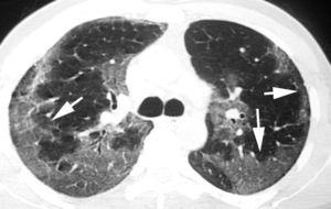 Imagen TCAR centrada en lóbulos superiores en paciente con neumonía intersticial descamativa que muestra la presencia de opacidades pulmonares en «vidrio deslustrado» de localización periférica (flechas).