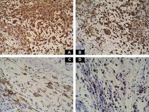 Immunohistochemistry. A, Intense positivity of the tumor cells for vimentin. B, Moderate positivity for CD68. C, Positivity for CD34. D, Ki-67 expression in the tumor, demonstrating a proliferation index of 20% to 30%.