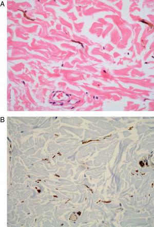 badanie histologiczne. A, pigmentowane śródskórne melanocyty wrzecionowate (hematoksylina-eozyna, oryginalne powiększenie x400). B, dodatnia odporność z białkiem s-100 (immunoperoksydaza, oryginalne powiększenie x200).