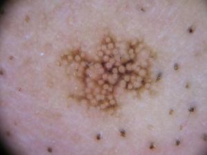 Dermoscopic image of the lesion in patient 2, in which grayish-brown perifollicular dots, rhomboidal structures, and an annular-granular pattern are visible.