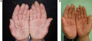 A, Patient with hyperkeratotic eczema of the hands before treatment with oral alitretinoin. B, Clear hands after a month of treatment.